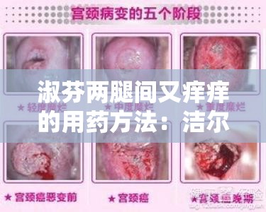 淑芬两腿间又痒痒的用药方法：洁尔阴洗液