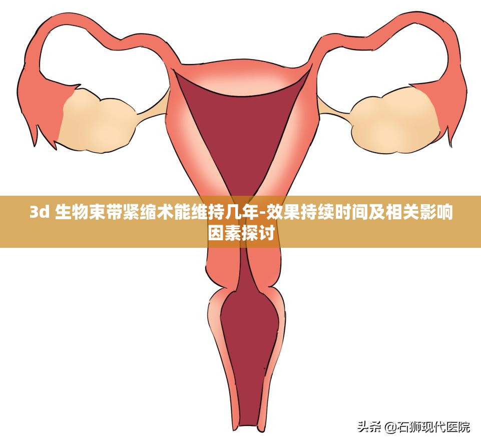 3d 生物束带紧缩术能维持几年-效果持续时间及相关影响因素探讨
