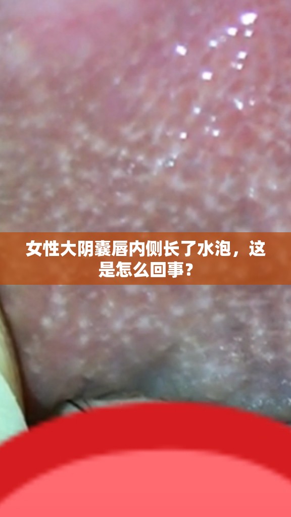 女性大阴囊唇内侧长了水泡，这是怎么回事？