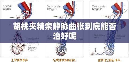 胡桃夹精索静脉曲张到底能否治好呢