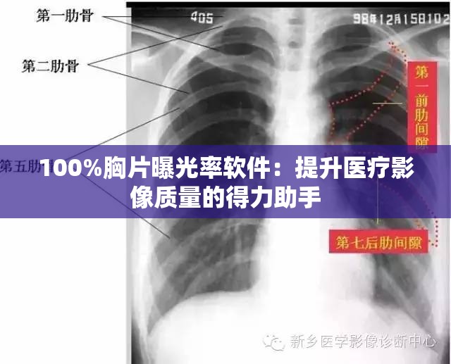 100%胸片曝光率软件：提升医疗影像质量的得力助手